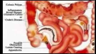 The Shocking Truth About Colon Hydrotherapy [upl. by Sotsirhc]