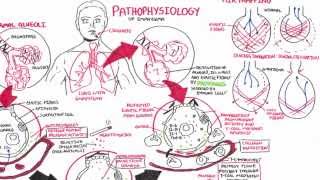 Emphysema  Pathophysiology COPD [upl. by Nylrahs304]