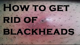 how to get rid of blackheads [upl. by Riva913]