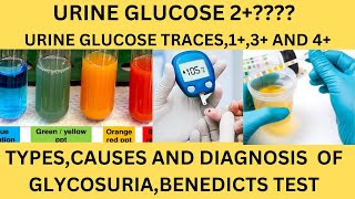 GLUCOSE SUGAR IN THE URINEBENEDICTS TESTGLUCOSE OXIDASE REAGENT STRIPSGLUCOSE 1GLUCOSE TRACES [upl. by Elleinnod242]