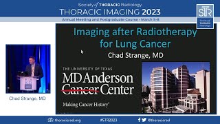 Imaging after Radiotherapy for Lung Cancer [upl. by Atteuqehs]