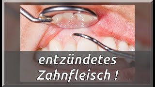 7 Lösungen gegen entzündetes Zahnfleisch [upl. by Lyrad]