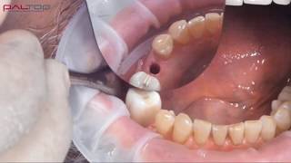 PALTOP Flapless Guided Implant Surgery using PAI  Dr Michael Klein [upl. by Deny785]