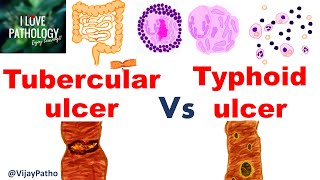 Intestinal ulcers TUBERCULAR VS TYPHOID ULCER [upl. by Buzz]