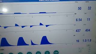 How to measure end tidal CO2 of a patient in ventilator end tidal carbon dioxide levels measurement [upl. by Ainot]