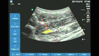 Ultrasound guided anterior sciatic nerve block [upl. by Enej]