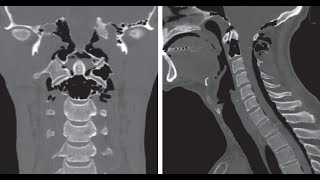 Idiopathische kraniozervikale Hyperpneumatisation mit Pneumorrhachis [upl. by At864]