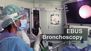 EBUS Bronchoscopy a test for lung cancer staging [upl. by Mesics414]