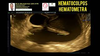 Hematocolpos Hematometra [upl. by Dorreg902]