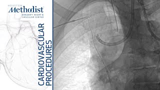 Superior Vena Cava Stenting Maham Rahimi MD Luis Gomez MD [upl. by Steffie]