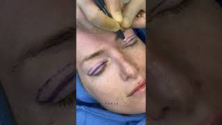 Upper Blepharoplasty for Hooded Upper Eyelids  Dr Kami Parsa  Droopy Eyelids [upl. by Neleag957]