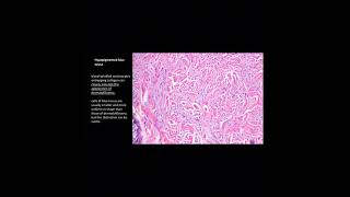 Blue nevus  Histology  understanding dermatopathology [upl. by Samira74]