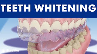 Teeth whitening  How is it done © [upl. by Eliam548]