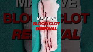 Shocking Footage Massive Blood Clot Removal From Artery shortsviral vascularsurgeon [upl. by Auberta]