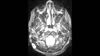 Intracranial Hypotension [upl. by Enylrac57]