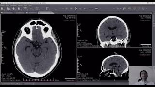 Calcificações intracraniananas sem significado clínico provavelmente  Parte 1 [upl. by Rimola707]