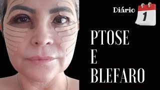 PTOSE E BLEFAROPLASTIA DIA 1 [upl. by Oiratno581]