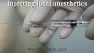 Spinal anesthesia [upl. by Deanne]