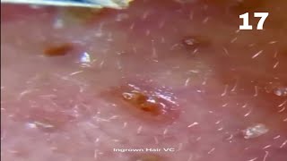 Nose Blackhead Removal Whiteheads On The Nose The Skin Is Dug Very Tightly Clip 17 [upl. by Senecal528]