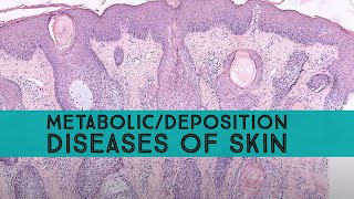 MetabolicDeposition Diseases of Skin amp Mimics Board Review for Dermpath Dermatology Pathology [upl. by Beaner]