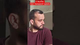 Hair transplant results in 2 Months  DHI Hair Transplant besthairtransplant [upl. by Niboc]