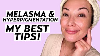 My Best Tips for Melasma amp HyperpigmentationProne Skin  Skincare with Susan Yara [upl. by Tawnya]