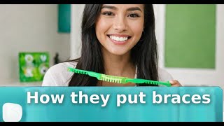 How they put braces  Dental Health Hub [upl. by Ramiah]