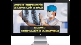 CURSO DE INTERPRETACIÓN RADIOGRAFÍA DE TÓRAX IDENTIFICACIÓN RADIOLÓGICA DE LAS NEUMONÍAS [upl. by Monteith]