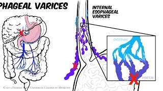 Portal Hypertension Animated Review [upl. by Janna]