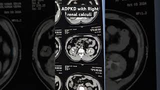 ADPKD with Right renal calculi cturography renalstones urology shorts medicos [upl. by Calhoun]