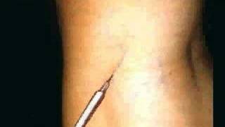 Tratamiento esclerosante de varices  Sclerosing Treatment of Varicose Veins  Sclerotherapy [upl. by Carder]