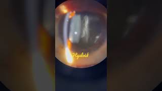 Anterior Hyaloid face  Slit lamp examination [upl. by Htes618]