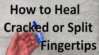 How to Heal Cracked or Split Fingertips [upl. by Orianna236]