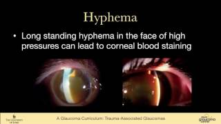 26 SECONDARY GLAUCOMAS Trauma associated Glaucomas Angle Recession hyphema Ghost Cell Siderosis [upl. by Aivital]