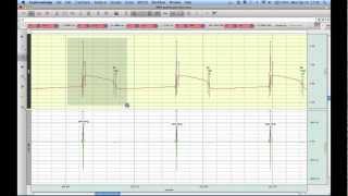 Monophasic Action Potential Analysis [upl. by Manny779]