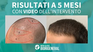 Trapianto capelli Micro FUE prima e dopo con video dellintervento e risultati a 5 mesi [upl. by Nwahsyd]