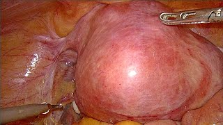 Large fibroid uterus TLH unedited [upl. by Schroeder]