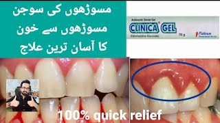 Clinica gel uses in Urdu Bleeding gums treatment  swollen guns easy treatment [upl. by Geirk]