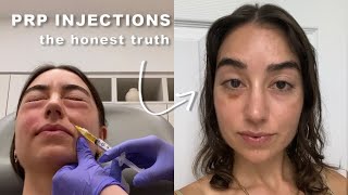 I Tried PRP Under Eye Injections so you dont have to Part 3 [upl. by Anale]