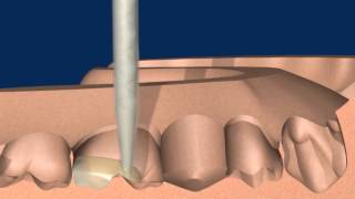 Provisorische Brücke mit Structur 3  Einfach ästhetisch stabil [upl. by Vogel]