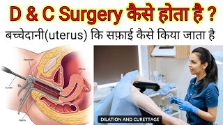 Dilation and curettage D ampC Dos amp Donts after DampC DampE FAQs D amp C सर्जरी कैसे की जाती है [upl. by Ealasaid26]