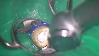 Sealer based obturation of Cshaped root canals in a retreatment case [upl. by Metah]