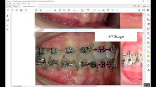 Fixed Orthodontic Appliances Part 5 [upl. by Ayahs391]