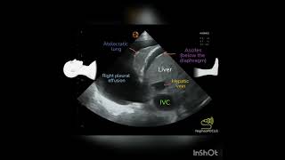 Pleural effusion on Ultrasound POCUS [upl. by Giacinta]