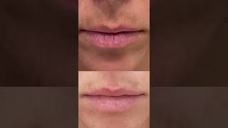 Hyperpigmentation Around Mouth Treatment That Works shorts [upl. by Kassey]