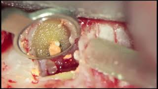 Endodontic MicroSurgery [upl. by Bordie]