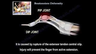 Boutonniere Deformity  Everything You Need To Know  Dr Nabil Ebraheim [upl. by Lever]