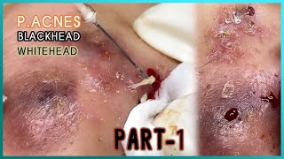 Big Cystic Acne Blackheads Extraction Blackheads amp Milia Whiteheads Removal Pimple Popping [upl. by Luhem853]