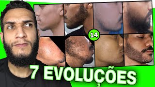 EVOLUÇÕES COM MINOXIDIL  7 evoluções 14 [upl. by Hsiri]