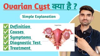 Ovarian Cyst in Hindi  Causes Symptoms And Treatment of Ovarian Cyst [upl. by Alister]